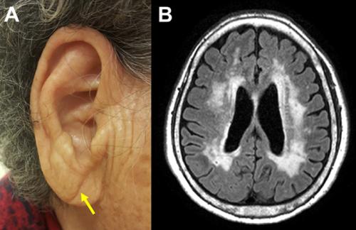 대각선 귓불주름 사진(A)과 대뇌백질변성(사진B) <출처:경희의료원>