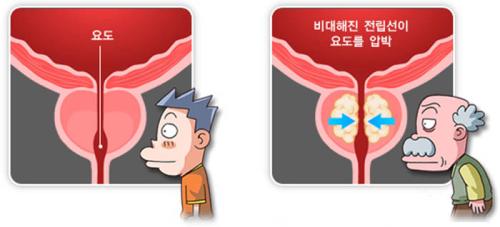 전립선 비대증 (이미지출처 : 국가건강정보포털)