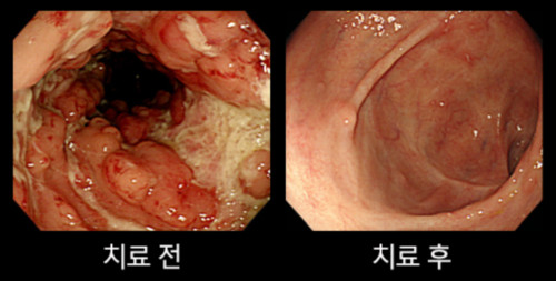 ▲치료 전후 내시경(사진=순천향대학교 부천병원)