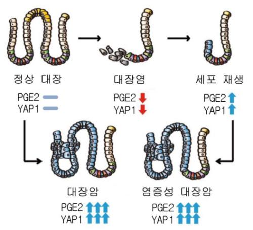 ▲새로 발견된 대장암 발병 기전 (그림=서울아산병원)