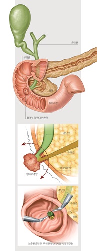 ▲십이지장팽대부 로봇수술 모식도 (분당 차병원 제공)