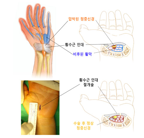 
	손 내부 구조와 수술법을 소개한 그림이다.
