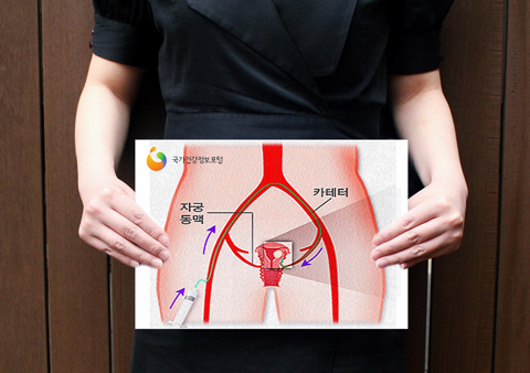 
	자궁에 칼을 대지 않고 자궁근종을 없애는 자궁근종동맥색전술이 주목을 받고 있다.
