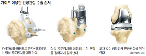 가이드(맞춤형 절삭유도장치)