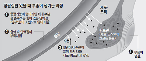 콩팥질환 있을 때 부종이 생기는 과정 설명도