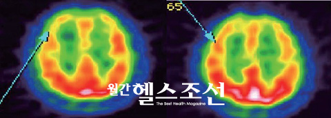 
	EMDR 치료 후(왼쪽)와 치료 전(오른쪽)의 뇌 사진. 치료 전에는 전측두엽(화살표)이 주황색으로 매우 활성화돼 있는데, 치료 후에는 전측두엽 활성도가 떨어져 노란색으로 변해있다. EMDR치료 후 트라우마를 떠올리고 집중하는 정도와 비율이 떨어진 것이다.
