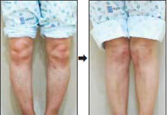 	다리가 O자로 휜 ‘내반슬’(왼쪽)과 수술로 교정한 무릎
