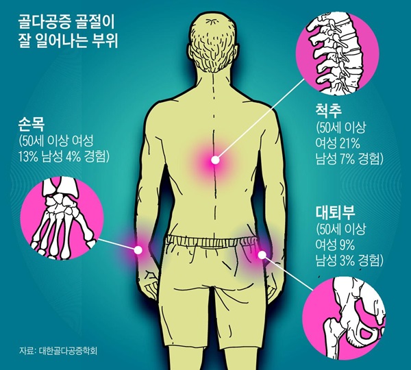 골다공증 골절이 잘 일어나는 부위