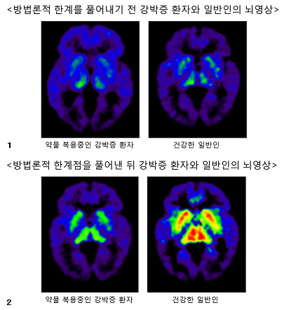 강박증 환자와 일반인의 뇌영상 비교 사진