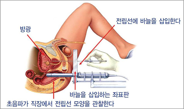 브라키테라피 시술 모식도