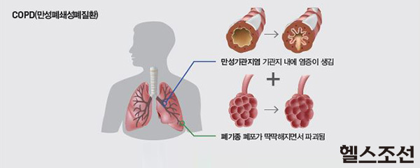 COPD(⼺ȯ) ϷƮ