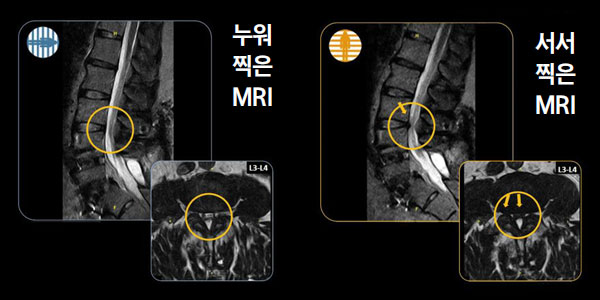  MRI( ) Ÿ ʾҴ ô 45 (׶ κ) ũ   MRI Կ Ȯϰ Ÿ.
