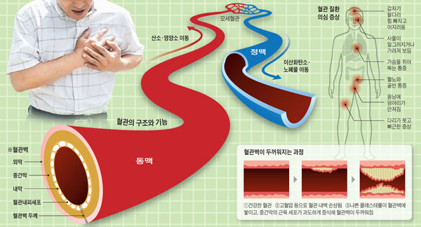 [H story] 혈관 건강의 지표, 혈관벽 두께