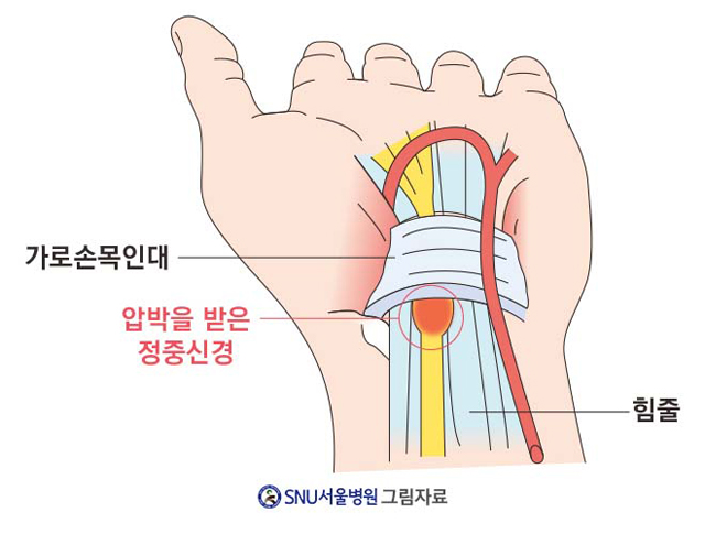안산 손목 통증이 계속되면 손목터널증후군입니까?