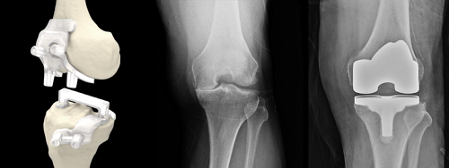 무릎 퇴행성관절염, 환자 맞춤형 인공관절(PSI)로 치료부담 줄여