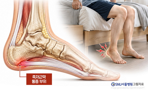 뒤꿈치가 아픈 ‘만성 족저근막염’ 주사치료부터 내시경 수술까지
