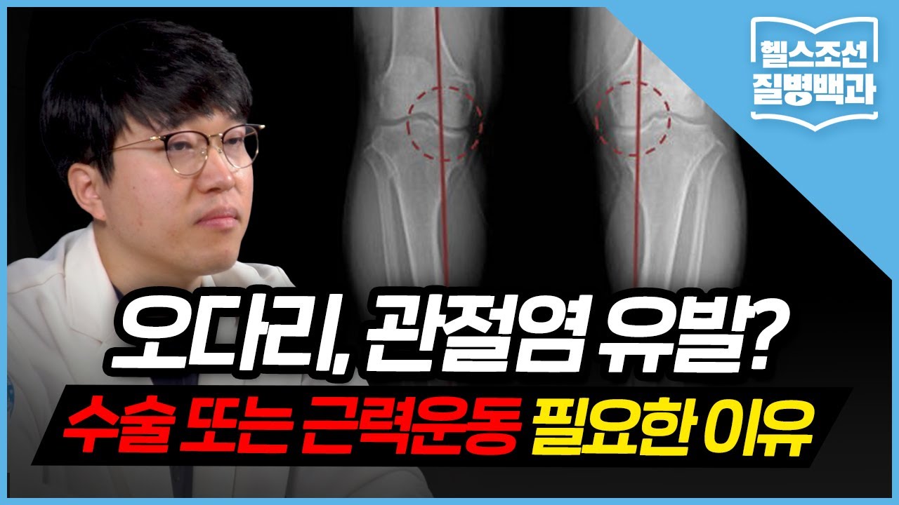 [오다리] 벌어진 다리 그냥 두면… '내측관절염' 악화될 수도