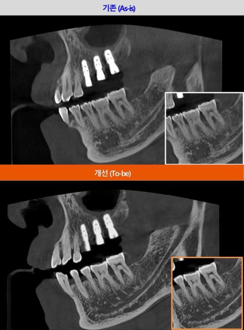 ���������ö�Ʈ�� ġ���� CBCT 'T2 Plus'�� ���� ����Ʈ����(SW) ���׷��̵带 ������ AI ��� ����ó�� ����� ����� �Կ� ���μ����� ���� ����Ʈ���� ������ ����ȭ�� ���� �ϼ����� ���� ȿ������ ������.