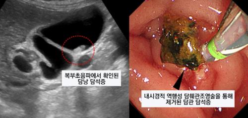 요로암의 원인과 담석치료에 대해 10