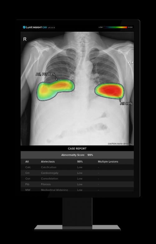  λƮ CXR(Lunit INSIGHT CXR)