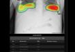  λƮ CXR(Lunit INSIGHT CXR)