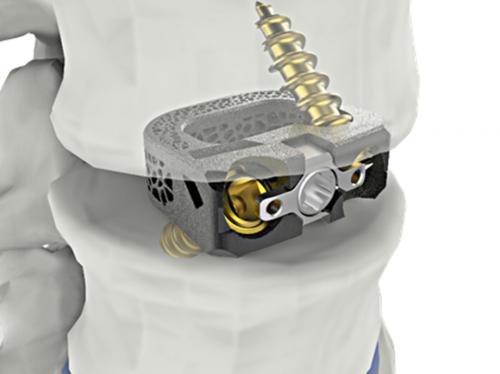 &nbsp;ô ձ&nbsp;Ͻ̽(UniSpace?? TPLIF Cage,&nbsp; ) ڸ&nbsp;FDA&nbsp; ȹߴ.<br>