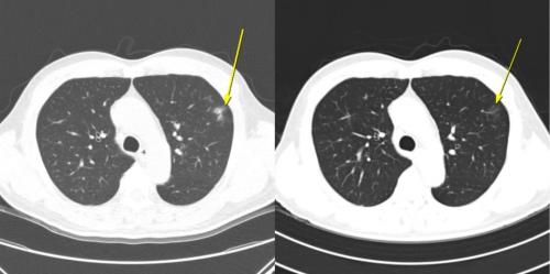  Ͻ 鿪  :&nbsp; ȯڴ AteBeva ġ 3°    CT()  ֺο ̼   Ÿ, 6° CT() ڿ ҽǵǴ  . ġ ӵ,  κ (PR) ޼߰  19.7  (PFS) ߴ.