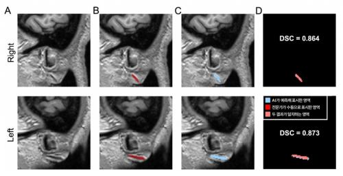 3���� ���� �̹���(A)�� ���� �������� �������� ���� ǥ���� �ָ�(B)�� AI�� ������ �ڵ����� ǥ���� ����(C).DSC ���� �� ������ ��ħ ������ ��ġȭ�� ������, AI�� �������� ���� ��ġ�ϰ�(�� 87%) �ָ��� ã�Ƴ´ٴ� �ǹ̸� ������. [�׸�������=�д缭��뺴��]