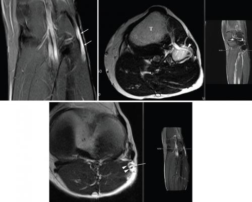 �㸮���� �����Ͽ� ������ ������ ���� �ٸ� ���� �����, ���Ƹ��� ���� �߱��� �������� �츮 ������ ���� ũ�� ���� �Ű� �ٹ��� �°�Ű濡�� �߻��� ��� ��ġ�� �缺���� '�Ű泻 ������'(ȭ��ǥ �κ�) MRI ���� �˻� ����.