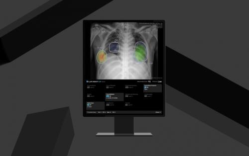 ��� ��� �������� AI ����м� �ַ�� '��� �λ���Ʈ CXR4'(�̹��� ����=���)