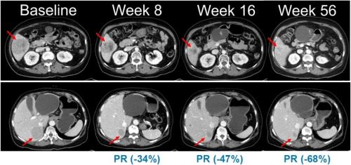 NRAS �������� ����� ȯ�ڸ� ������� ����� ���ٶ���հ� �ں��Ƽ�� ������ �ӻ���迡�� �ð� ����� ���� ���� ��ȭ�� ������ ���� CT ���� ����