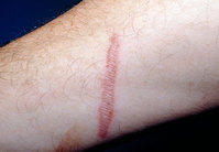 ���� ���� ��ó ��������? ���̶����� ġ�� ���Ÿ�� ���� �����