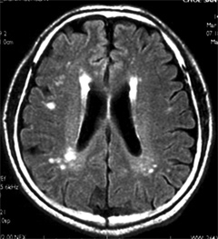 무증상성 뇌경색 MRI 사진