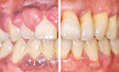 치은증식증 치료 전(왼쪽)과 후 사진