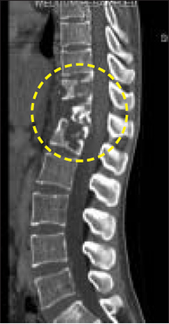 척추결핵 환자의 영상사진. 원 안이 결핵 감염 부위.