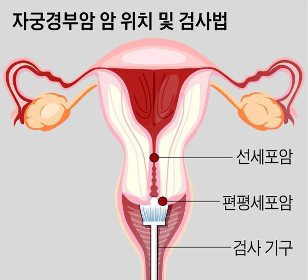 [그래픽] 자궁경부암 암 위치 및 검사법
