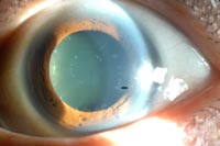 거짓비늘증후군 환자의 눈, 검은 화살표 부위가 수정체로부터 떨어져나온 이물질