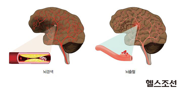 뇌경색과 뇌출혈의 혈관 내부 그림