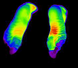 적외선으로 촬영한 수족냉증 환자의 발