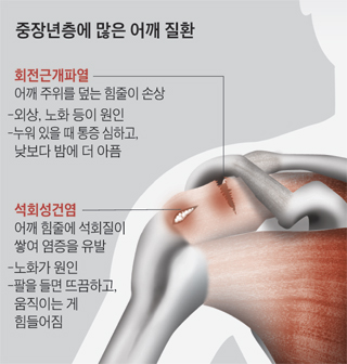 발목인대 파열수술, 증상 심해지면 2