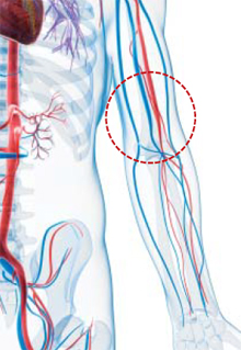 말초동맥질환은 팔다리로 향하는 동맥(동그라미 표시)이 막히는 질환이다.