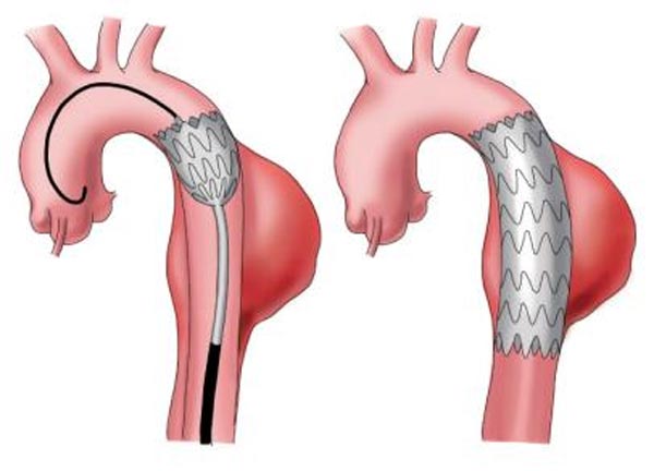 파열될 위험이 있는 흉부대동맥에 스텐트그라프트를 삽입하는 과정을 그린 모식도. 대퇴동맥을 통해 시술 도구를 집어 넣어 스텐트그라프트를 끼워 넣는다.