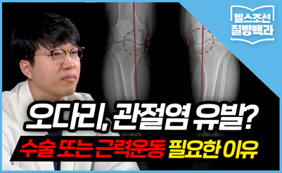 [질병백과TV] 벌어진 다리 그냥 두면… '내측관절염' 악화될 수도
