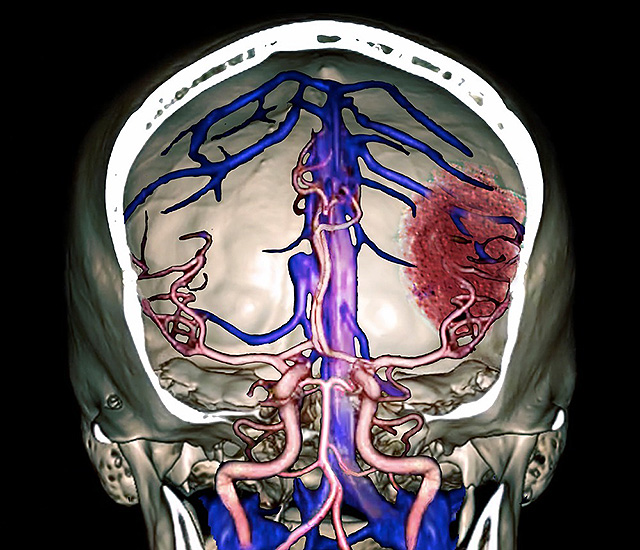 뇌출혈 사진