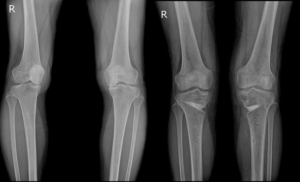 57세 여성의 근위경골 교정 절골술 전(왼쪽)과 후 다리 모양