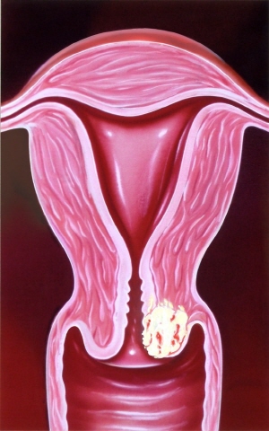 자궁경부암