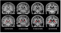 뇌 영상에서 맥락얼기의 부피(빨간색)가 치매가 진행함에 따라 더 증가한 것을 확인할 수 있다