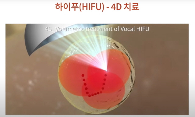하이푸 4D 부피입체 치료에 대한 그림