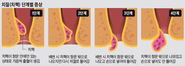 치핵 단계별 그래픽