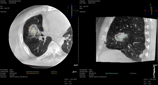 대장암 폐 전이 고주파 열 치료 시술 직후 Cone Beam CT 소견